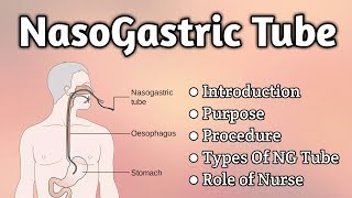 Nasogastric Tube Intubation [upl. by Eusebio]