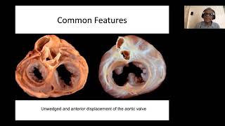 Philip Echo Webinar Series AV Septal Defect Echo Assessment by Dr Krishna Kumar Amrita Institute [upl. by Querida]