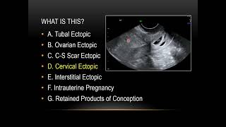 First trimester obstetrical ultrasound part 2 usual locations of ectopic pregnancy [upl. by Lenci]