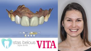 Vita Cad Temp cerec omnicam Stas Belous temporary crowns Suprinity or Emax veneers vitazahnfabrik [upl. by Goldston]