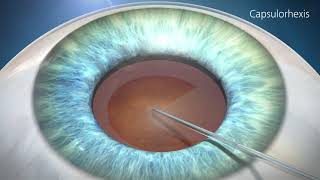 Cataract Surgery Animation [upl. by Ynnus]