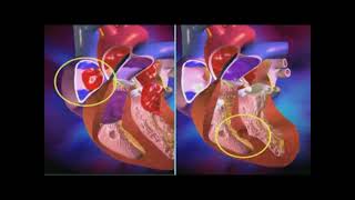 Cardiopathie congénitale [upl. by Everick]