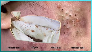 Big Cystic Acne Blackheads Extraction Blackheads amp Milia Whiteheads Removal Pimple Popping [upl. by Nyladnohr]