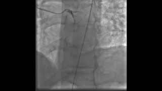 Stenting of the right coronary artery for inferior wall myocardial infarction Treatment [upl. by Nepets454]