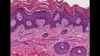 Histopathology SkinLamellar ichthyosis [upl. by Lanita459]