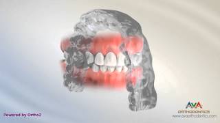 Orthodontic Retainer  Essix or Clear [upl. by Gnni]