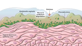 Bacterial Vaginosis  Pathogenesis [upl. by Yonita144]