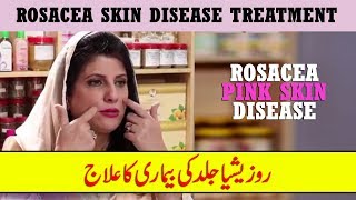 Rosacea Skin Disease Treatment by Dr Bilquis Shaikh  Rosacea Gulabi Skin Disease [upl. by Okramed]