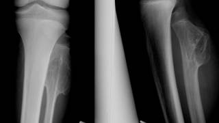 Osteochondroma of the fibula [upl. by Leanahtan8]