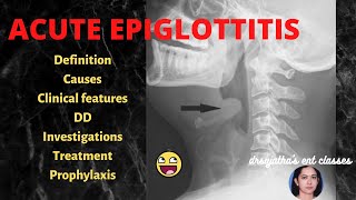 166Acute Epiglottitis  treatment of acute epiglottitis stridor epiglottis [upl. by Markson]