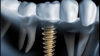 worauf kommt es an bei einem Zahnimplantat [upl. by Boeke922]
