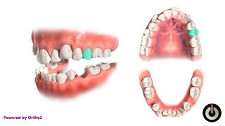 4 Second Premolar Extraction  Dental Braces  Temecula Valley CA [upl. by Niloc]