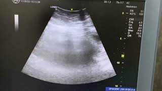 Strangulated umbilical hernia  that straight hyperechoic gaseous loop a hallmark of strangulation [upl. by Levinson]