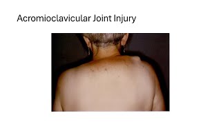 Acromioclavicular Joint Injury [upl. by Bud]