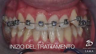 Trattamento ortodontico di Morso Inverso Anteriore con un apparecchio dentale fisso [upl. by Darwen]