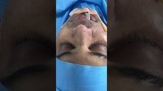 Radix and alar base reduction nose contouring surgery [upl. by Nahor86]