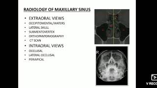 Maxillary sinus imaging and sinusitis [upl. by Rizas]