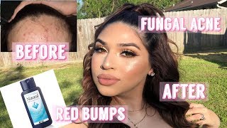 How to clear Tiny Red Bumps on your face  Fungal Acne Skin Care Routine [upl. by Liek433]