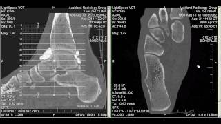 CT Arthrogram of my Ankle 2 April 2009 [upl. by Elbert]