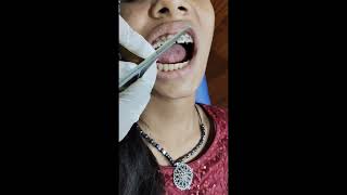 Best orthodontic treatment affordabledentist dentistnearby dentist [upl. by Eirrem]