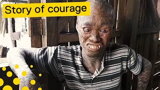 Man With Rare Skin Condition Emotional Story [upl. by Yllas]