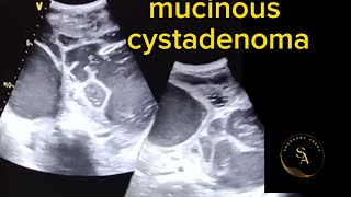 Ultrasound Imaging mucinous Cystadenoma [upl. by Geraldina13]