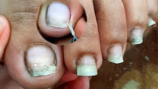 Satisfying Ingrown Toenail Removal  Dry Skin  Pedicure 116 [upl. by Ahsikam]