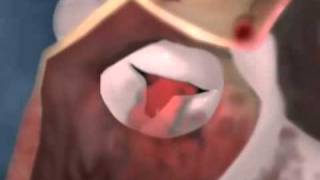 Aortic Valve Stenosis 3D Video on Healthline com [upl. by Tedi]