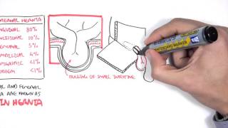 Introduction to Direct and Indirect Inguinal Hernia [upl. by Leggett]