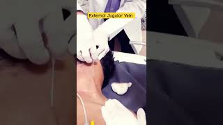 External Jugular Vein  Cannula insertion  Cannulation  EJV cannula ineet cannula cannulation [upl. by Wolliw]