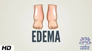 Edema Causes Signs and Symptoms Diagnosis and Treatment [upl. by Seuqramed773]