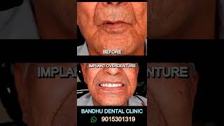 Implant Overdenture  very comfortable [upl. by Aicital]