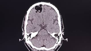 Dermoid cyst  ruptured   rare intracranial lesion [upl. by Roti]