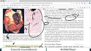 Chp11 Robbins Patho  Heart Pathology  Heart Effects of Non Cardiac TUmours  Carcinoid Heart [upl. by Chor14]