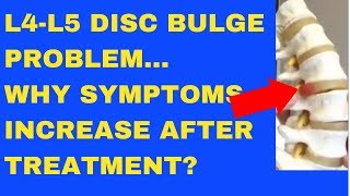 Why Does L4 L5 Disc Bulge Symptom Increase After Treatment  Answered by Chiropractor in Vaughan [upl. by Trilbi]