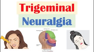 Trigeminal Neuralgia “Severe Facial Pain” Causes Pathophysiology Symptoms Diagnosis Treatment [upl. by Akemyt]