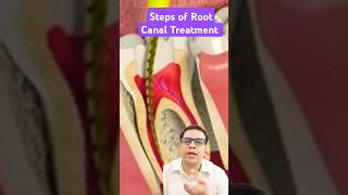 steps of root canal treatment shortvideo shortsviral shorts short [upl. by Goer831]