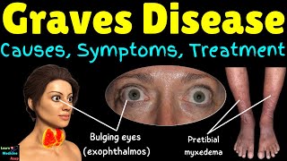 Graves Disease – Causes Symptoms Diagnosis and Treatment  Graves Disease Explained [upl. by Nalaf]