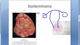 Pathology 747 b DysGerminoma tumor microscopy histology gross [upl. by Yrot]