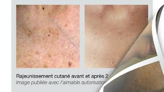 La révolution de lépilation laser avec lElite iQ de Cynosure [upl. by Ennaul]