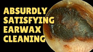 ABSURDLY Satisfying Earwax Cleaning [upl. by Casmey]