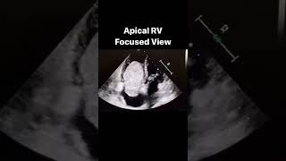 Diagnosis echocardiography rightatrialmyxoma Case Credit Dr Lucia Fernandez [upl. by Pontone]