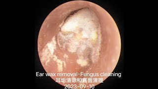 Ear wax removalFungus cleaning 耳垢清除和真菌清理20230910 [upl. by Lukey]