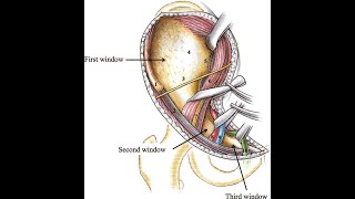 Ilioinguinal Approach to the Pelvis [upl. by Artina]