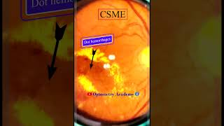 Diabetic Retinopathy  CSME  Retina  Short Video 170 akleshkumar optometrist [upl. by Saba]