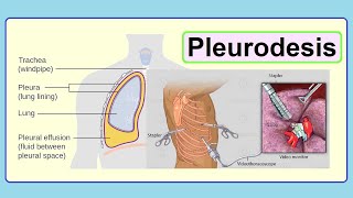 pleurodesis [upl. by Laniger]