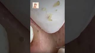 Blackheads Removal  Acne Treatment and Very Satisfying Satisfying Pimple pop blackheads [upl. by Anul]