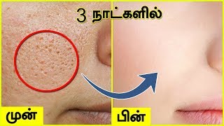 முகத்தில் உள்ள சிறுசிறு குழிகள் OPEN PORES மறைய  Open Large Pores on Face [upl. by Publias]