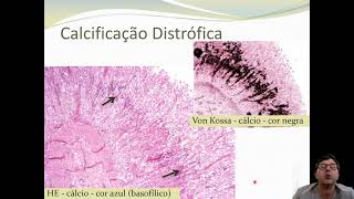 Patologia Geral  Calcificação e Concreções [upl. by Cooke159]