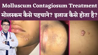 Molluscum Contagiosum Treatment In Hindi  Molluscum Contagiosum का इलाज  Molluscum कैसे पहचाने [upl. by Ahtelahs]